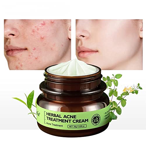 VIBRANT GLAMOUR Herbal Acne Treatment Cream Oil Control Brighten Nourish Brightening Shrink Pores Remove Scars Skin Care 30g